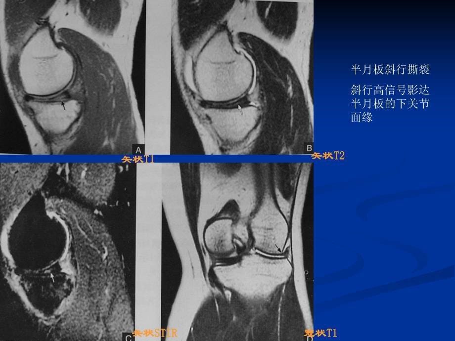 膝关节半月板损伤课件_14_第5页