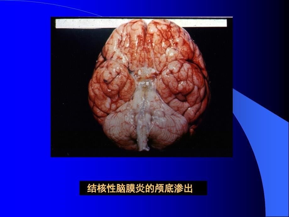 医学课件小儿结核性脑膜炎_第5页