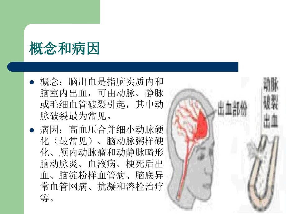 脑出血教学查房（1）ppt课件_第4页