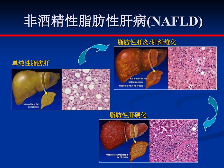 脂肪性肝病与冠心病厉有名_第4页