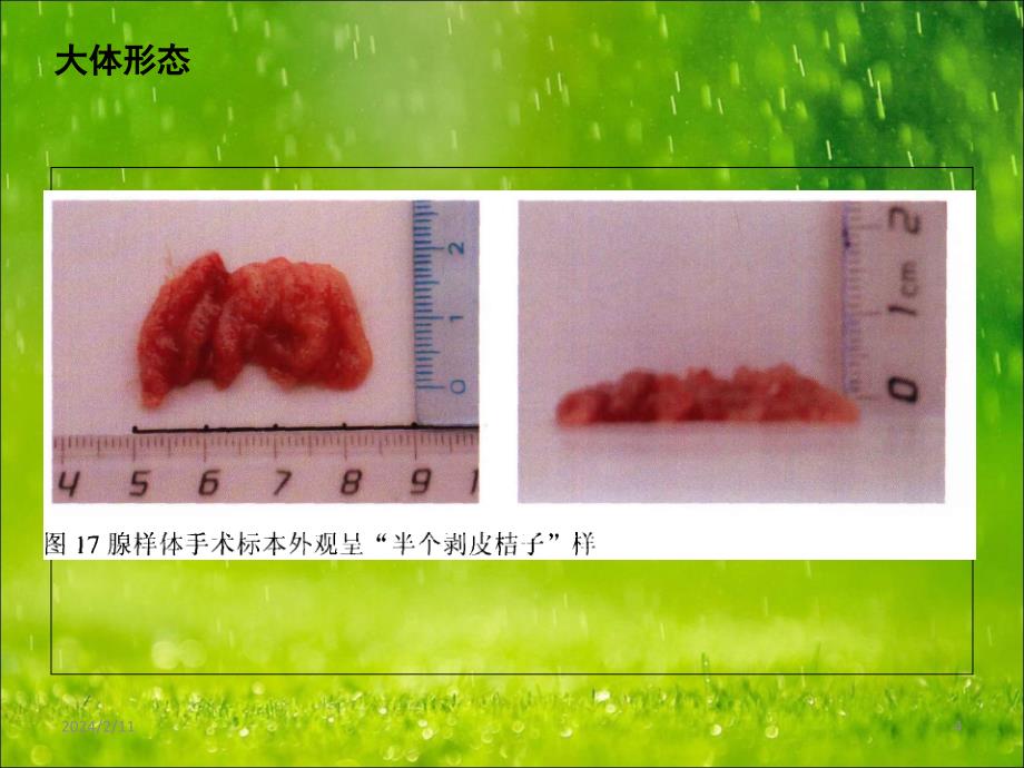 腺样体ppt课件_第4页