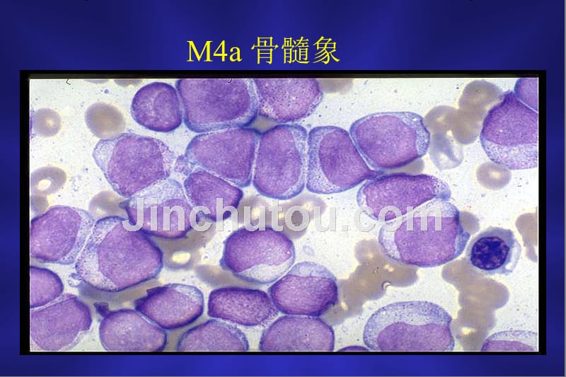 医学课件急性粒单核细胞白血病_第2页