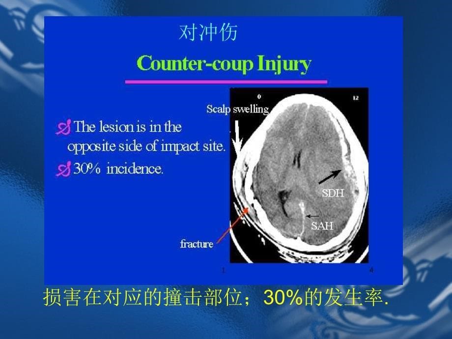 颅脑外伤及颅脑肿瘤的影像ppt课件_第5页