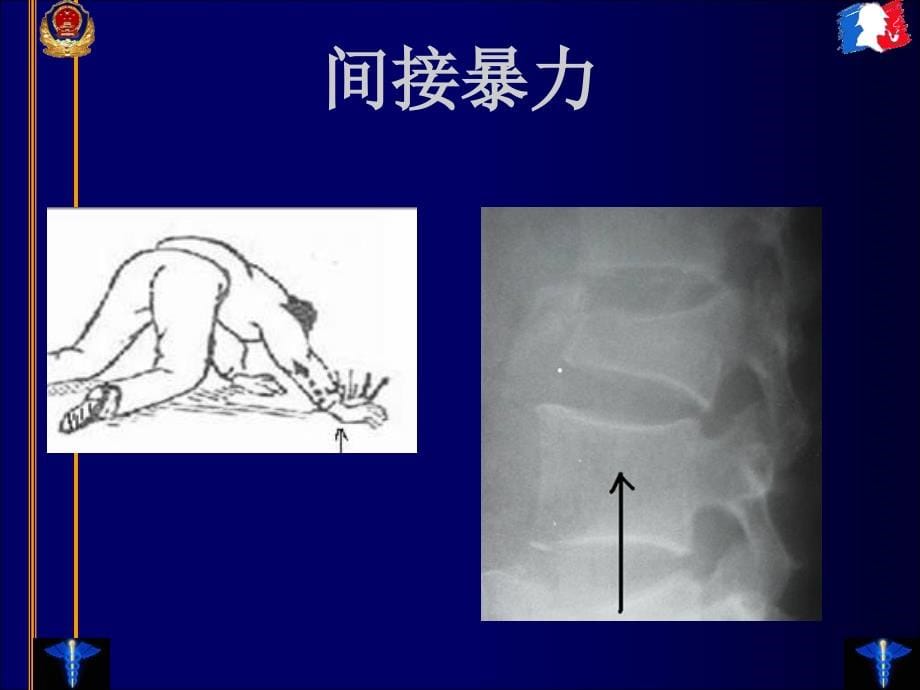 临床法医学四肢脊柱损伤ppt课件_第5页