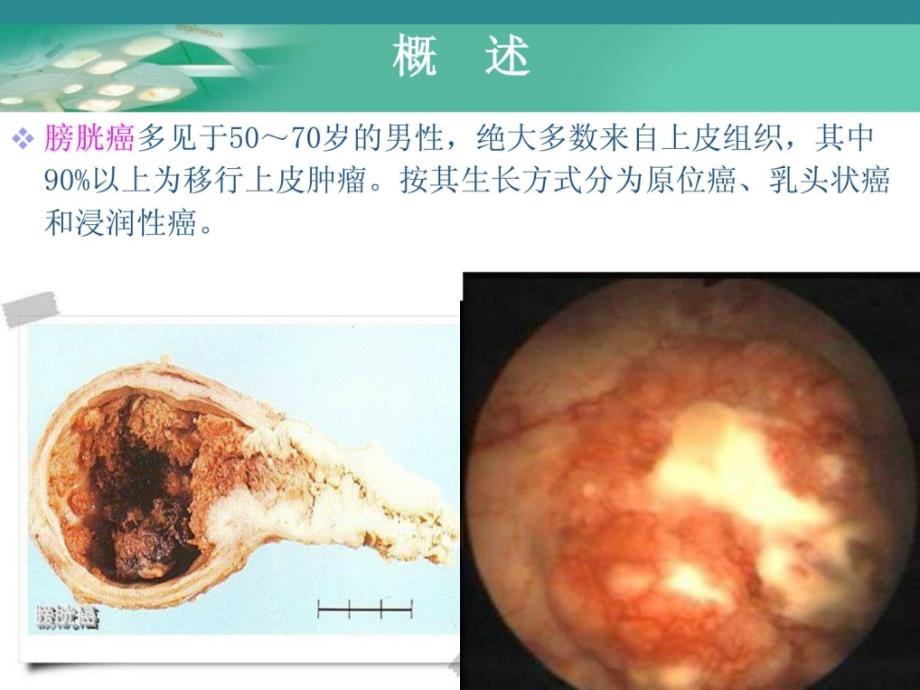 膀胱肿瘤病人的护理指南课件_第3页