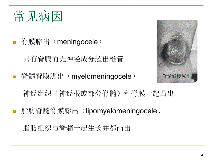 脊髓栓系综合征课件_1_第4页