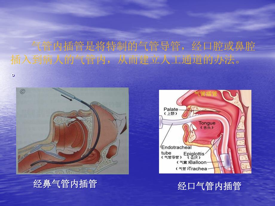 重要文件综合气管内插管术 ppt课件_第2页