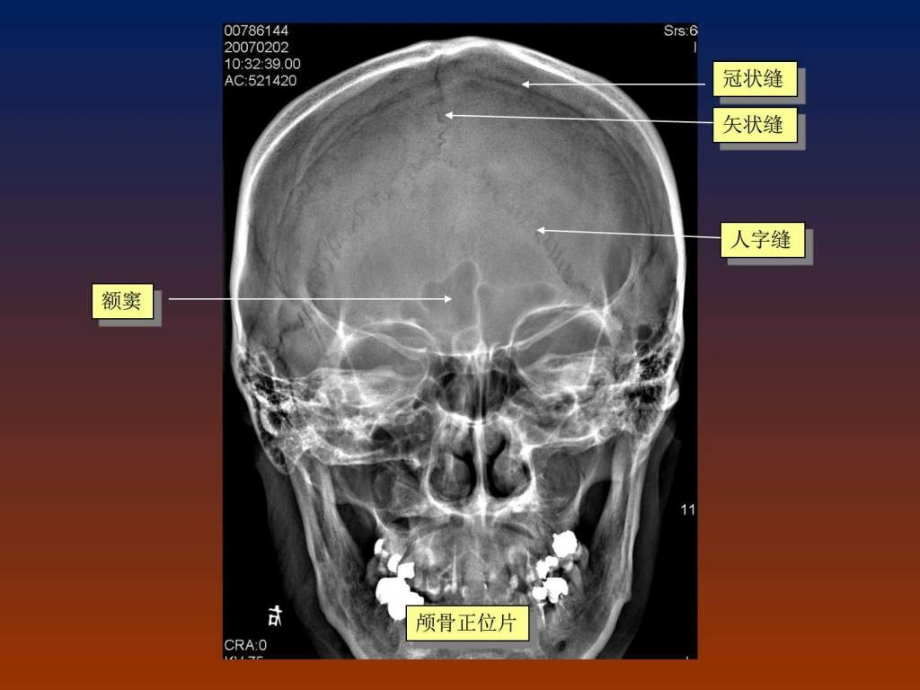 脑血管畸形影像学诊断图文课件_第2页