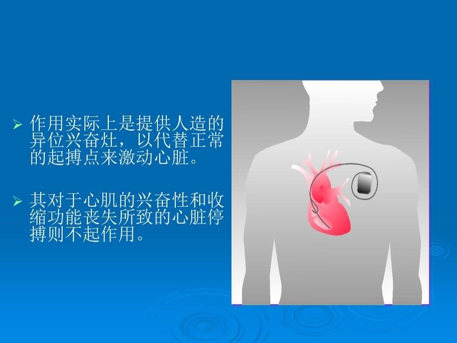 人工心脏起搏器ppt课件_第5页