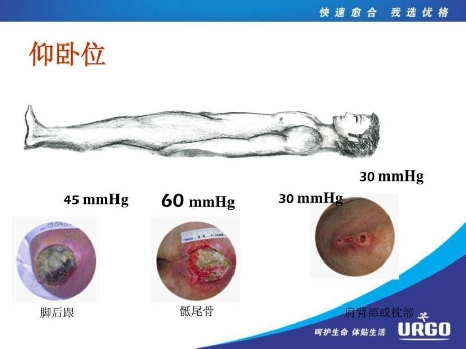 2014褥疮的预防和治疗课件_第5页