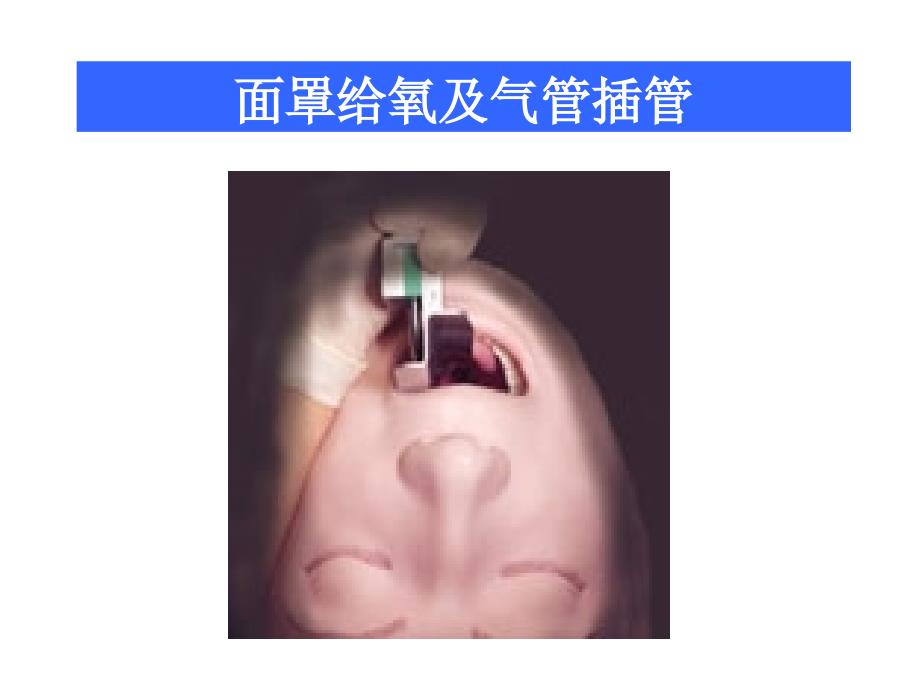 面罩给氧及气管插管ppt课件_第1页