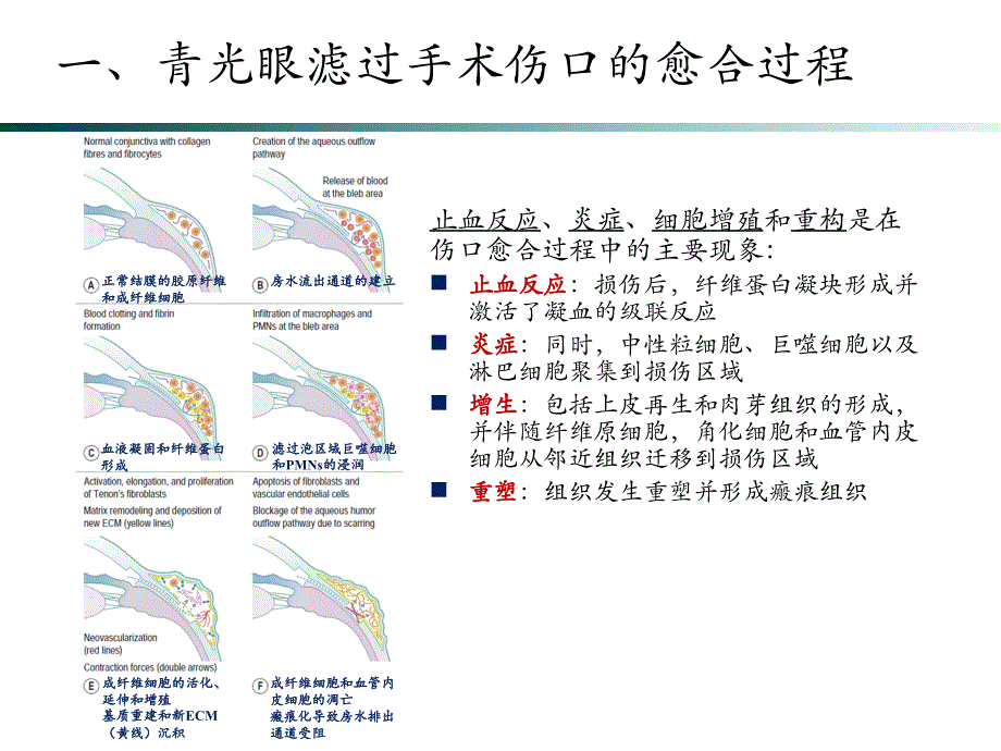 功能性滤过泡的维护ppt课件_第3页