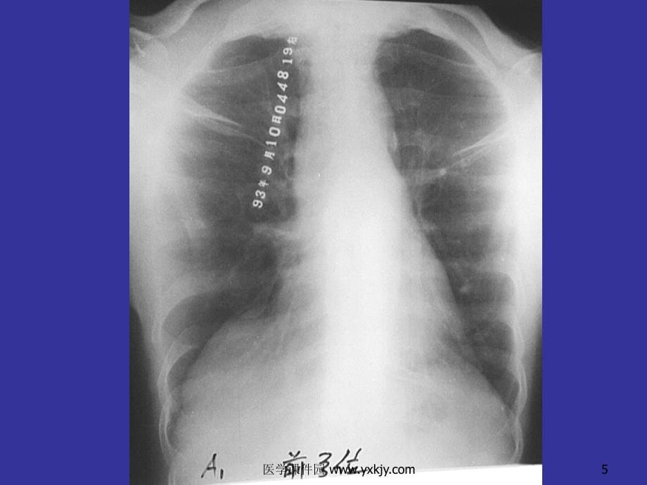 肺与纵隔正常表现医学_第5页