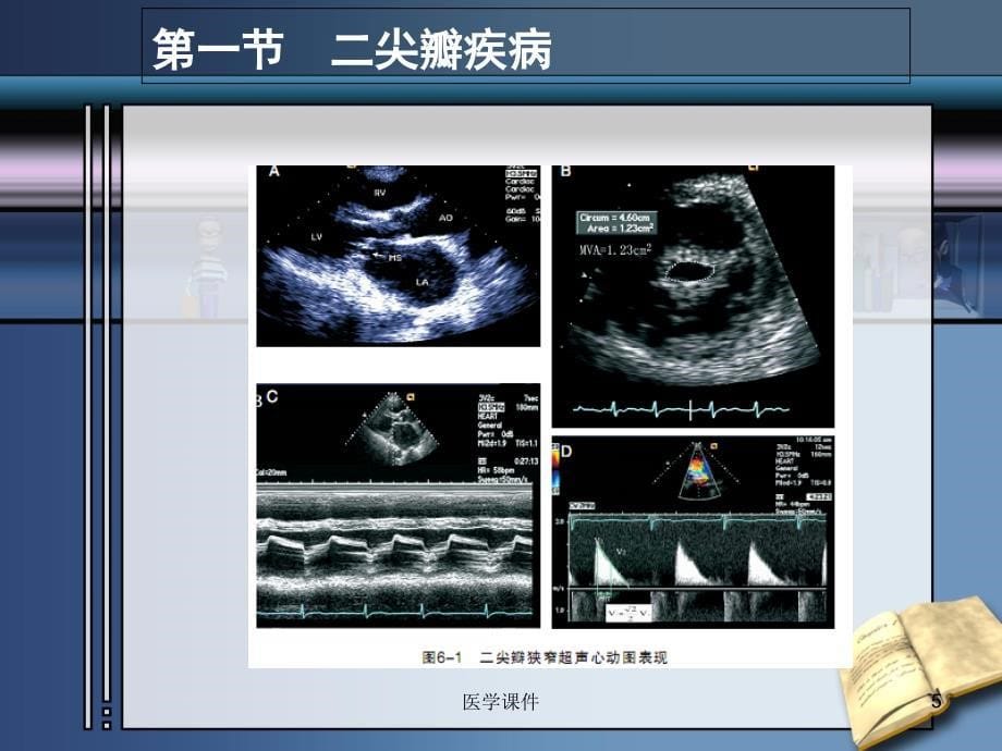 b超--瓣膜病课件_第5页
