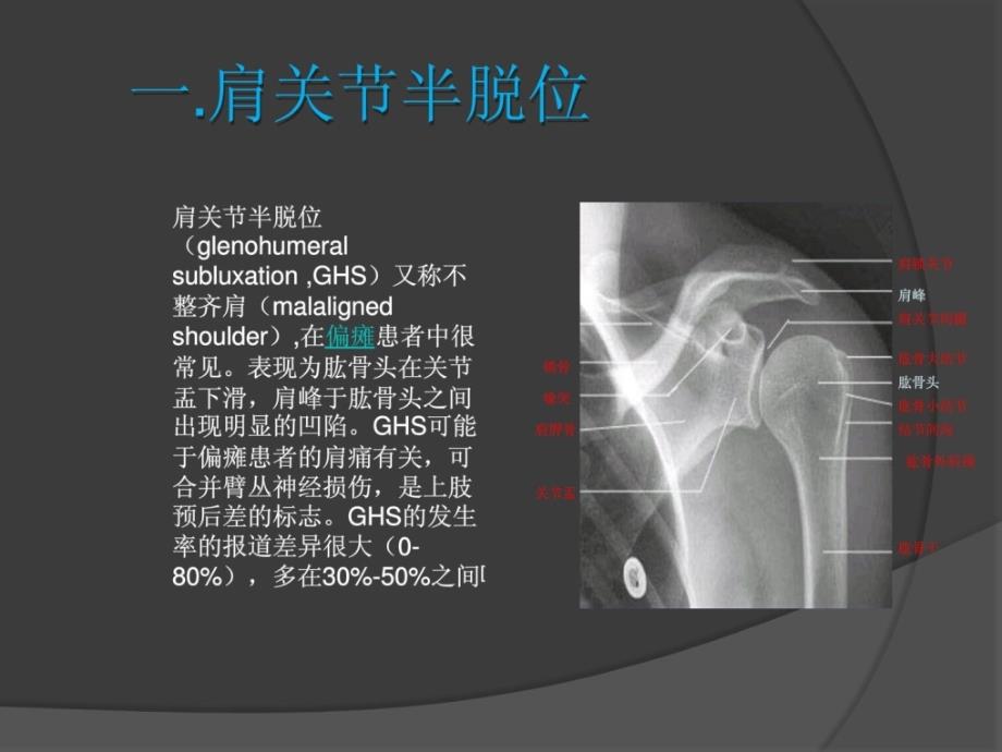 宝典肩关节半脱位肩手综合征的康复治疗课件_第2页