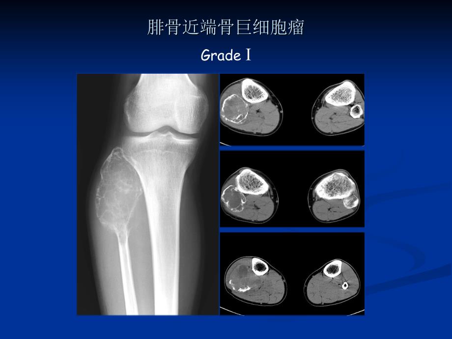 实习课件骨肿瘤肿瘤样病变_第3页