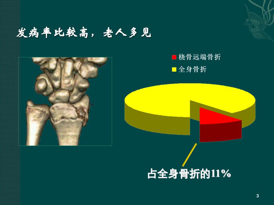 桡骨远端骨折课件_1_第3页