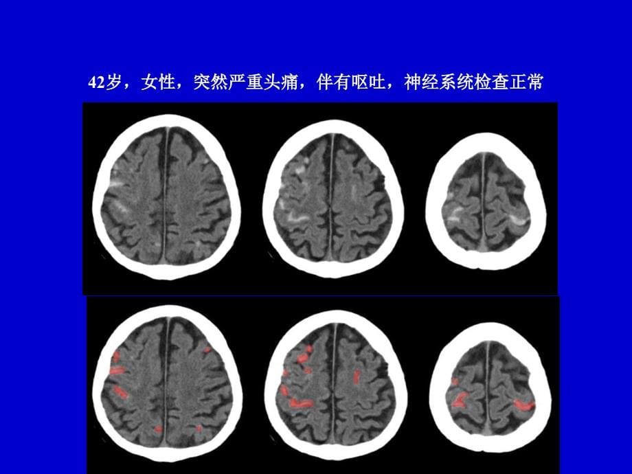 脑动脉瘤的影像学高旭光课件_第5页