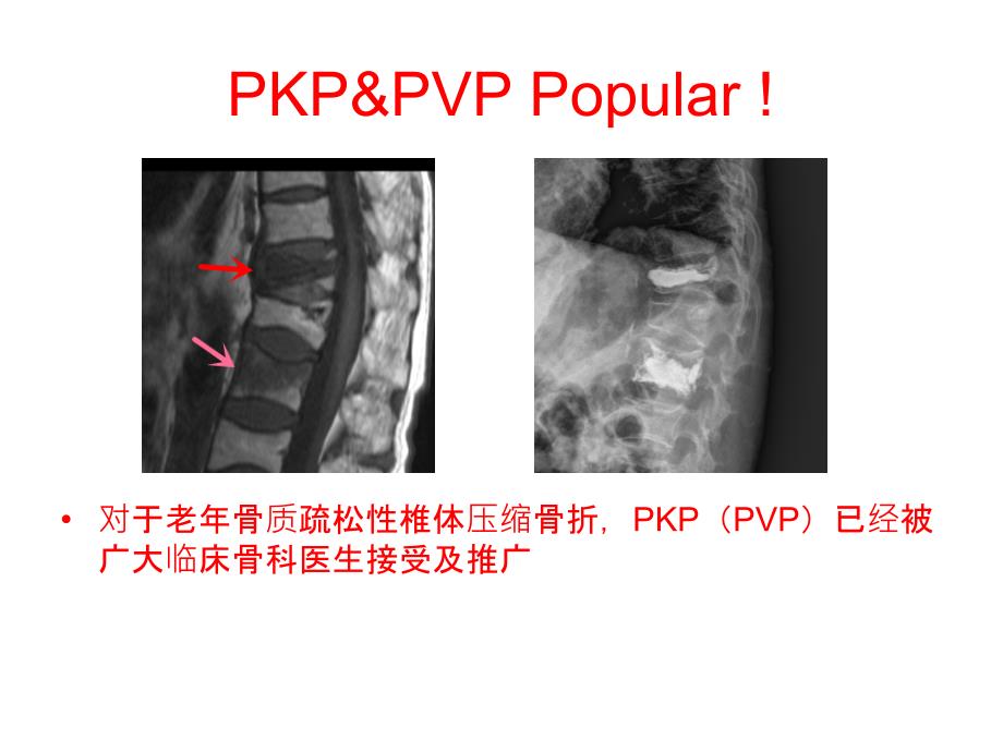 老年重度骨质疏松性腰椎管狭窄症的手术治疗课件_第3页