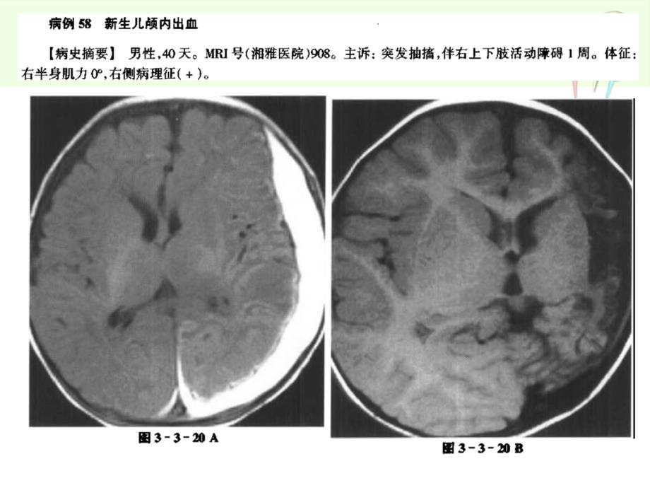 脑血管病mri诊断3动静脉畸形课件_第2页