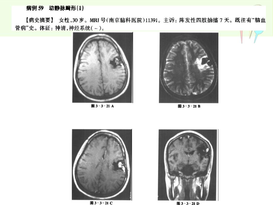 脑血管病mri诊断3动静脉畸形课件_第4页