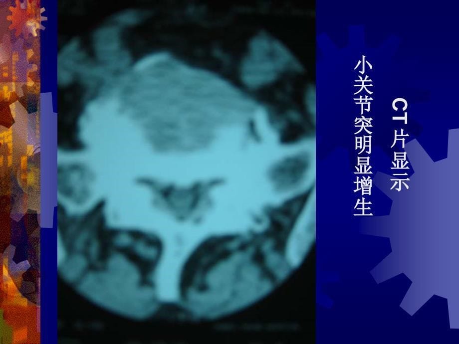 腰椎管狭窄症课件_5_第5页