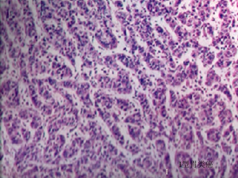 胃内分泌细胞及其肿瘤（一）课件_第5页