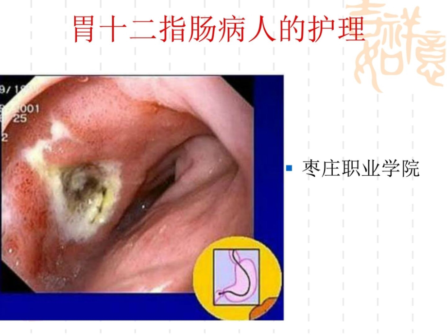 胃十二指肠溃疡胃癌病人的护理（）课件_第1页