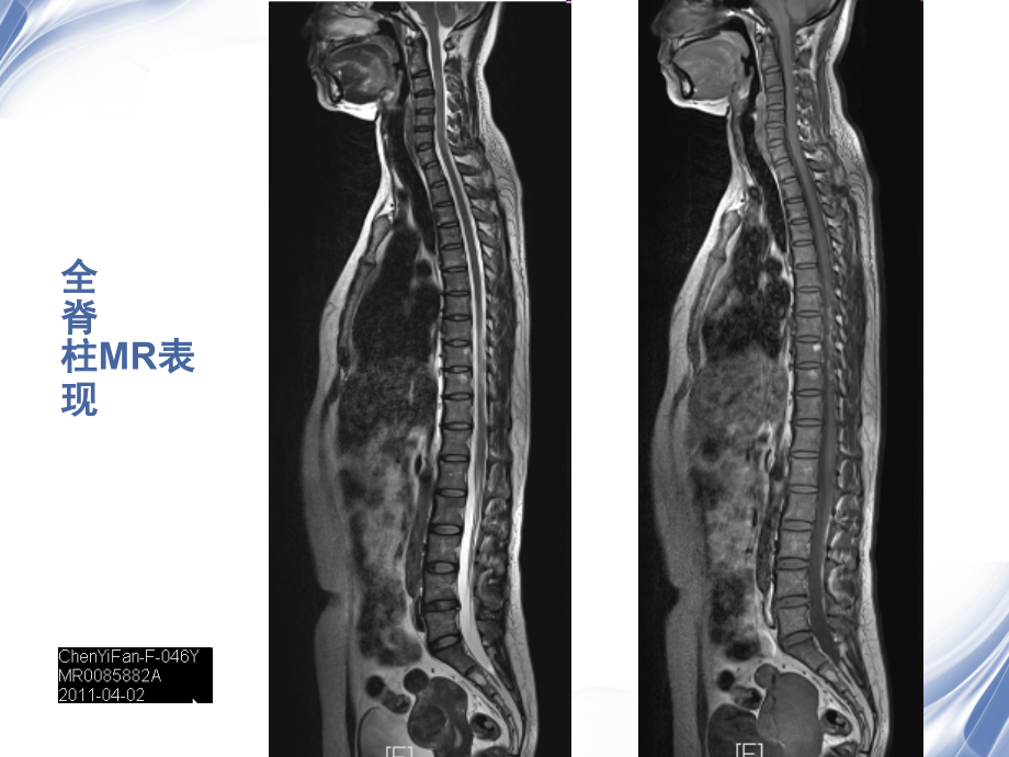 医学影像脊柱外伤影像学表现课件_第3页