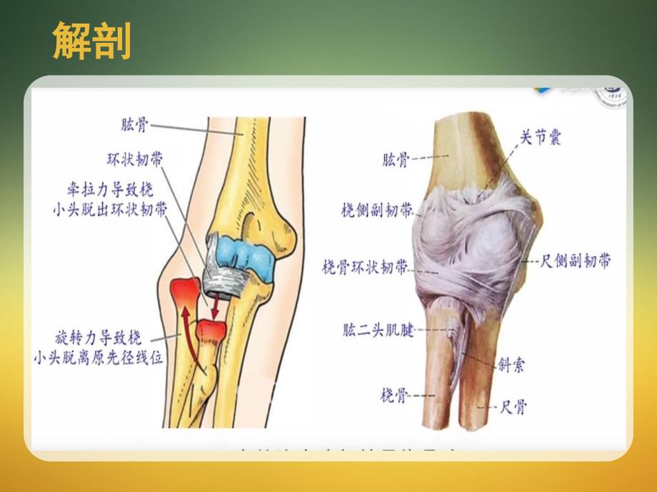 小儿桡骨小头半脱位课件_第3页