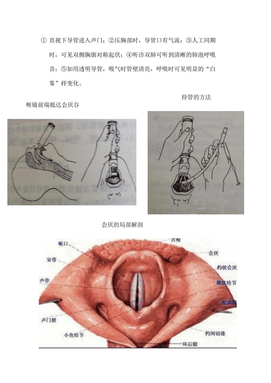 经口明视气管插管法_第2页