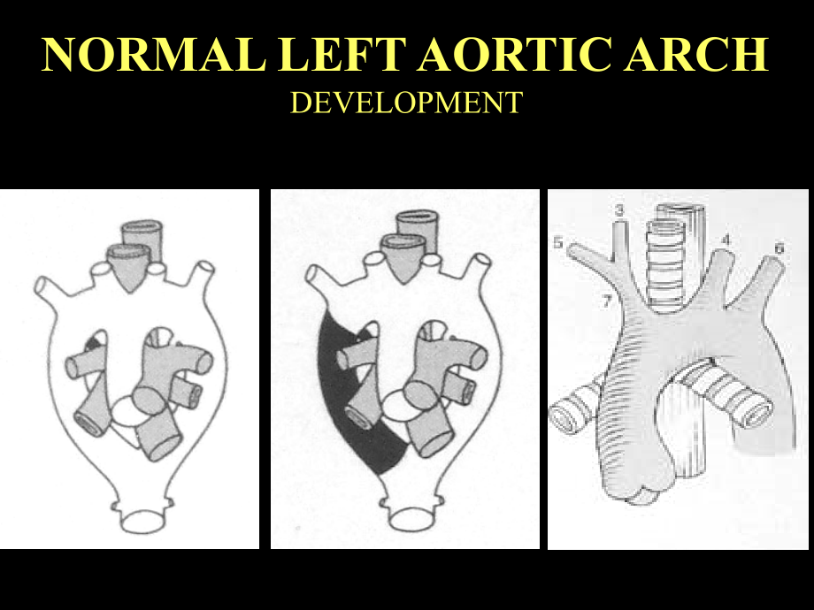 先天性主动脉疾病（congenital aortic disease）课件_第3页