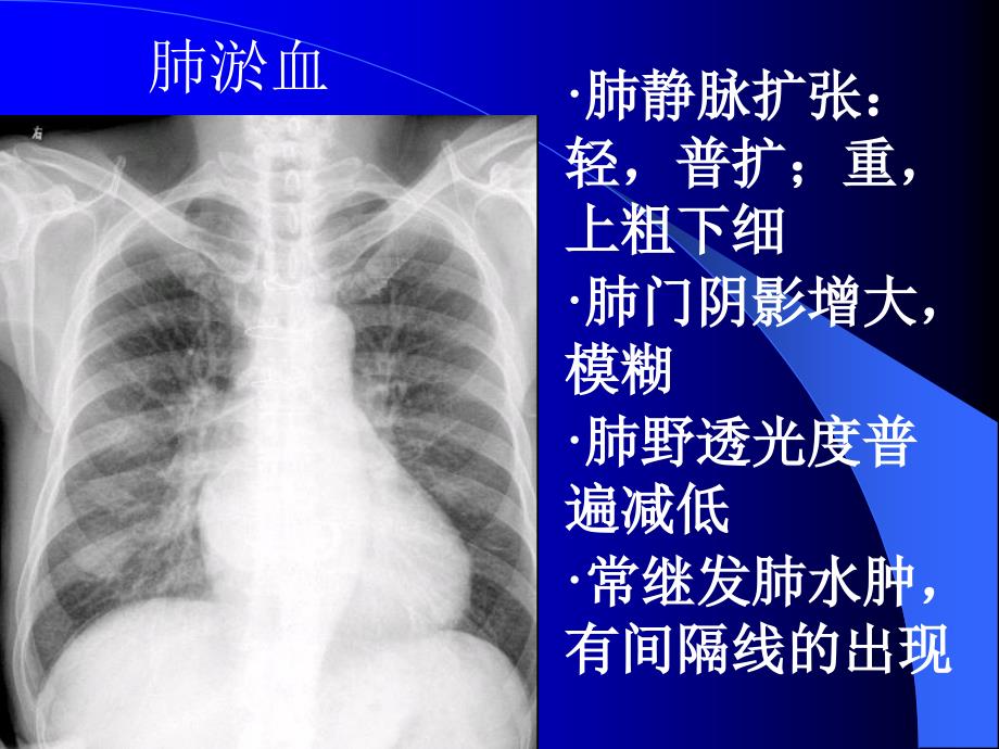 肺充血与肺淤血区别课件_第4页