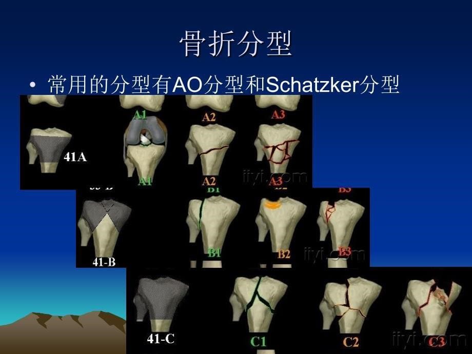 胫骨平台骨折的诊断及治疗（精品ppt）课件_第5页