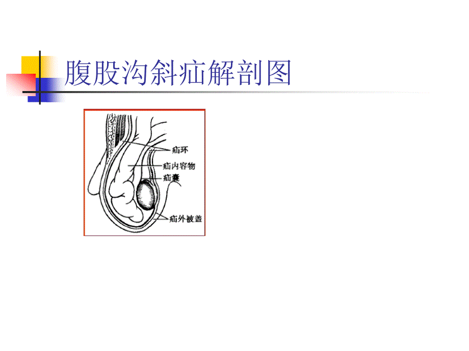 腹股沟疝的护理教学查房图文课件_第3页