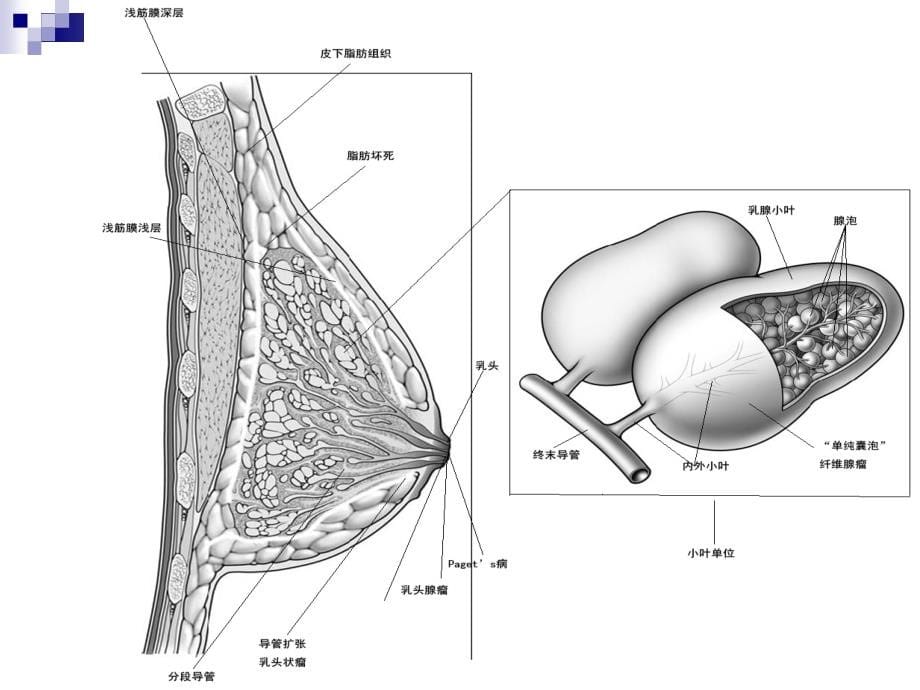 第32章 乳房疾病（武正炎）（《外科学》8年制第2版配套）课件_第5页