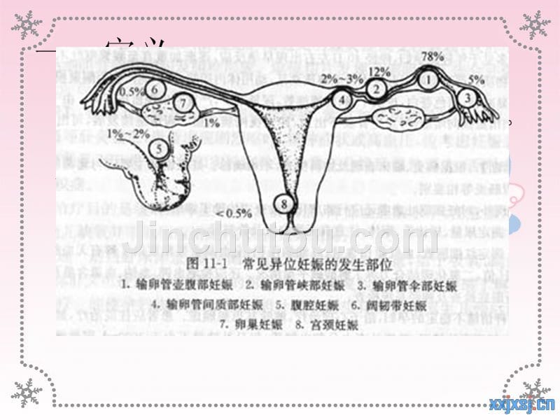 异位妊娠课件_4_第3页