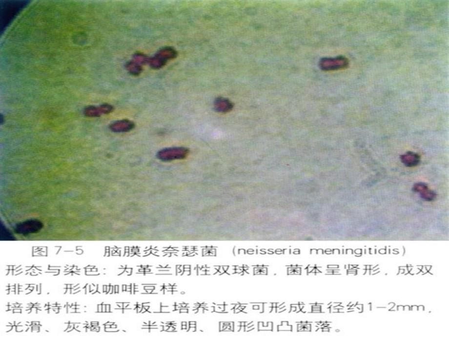 张伦理《传染病学》0412 流行性脑脊髓膜炎课件_第5页