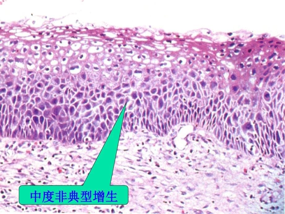 生殖系统和乳腺肿瘤课件_1_第5页