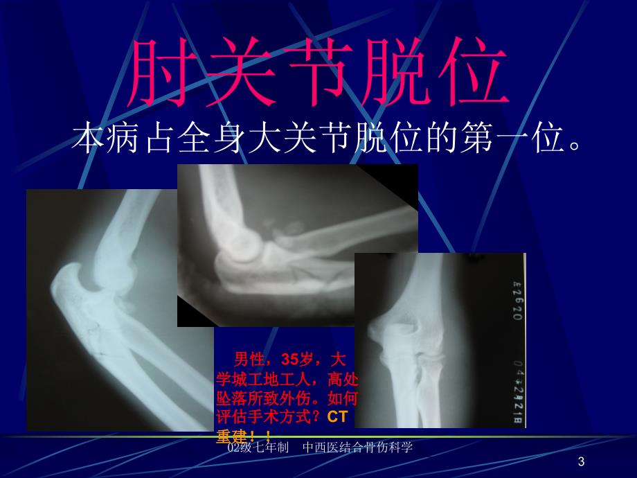 医药卫生肘关节脱位课件_第3页