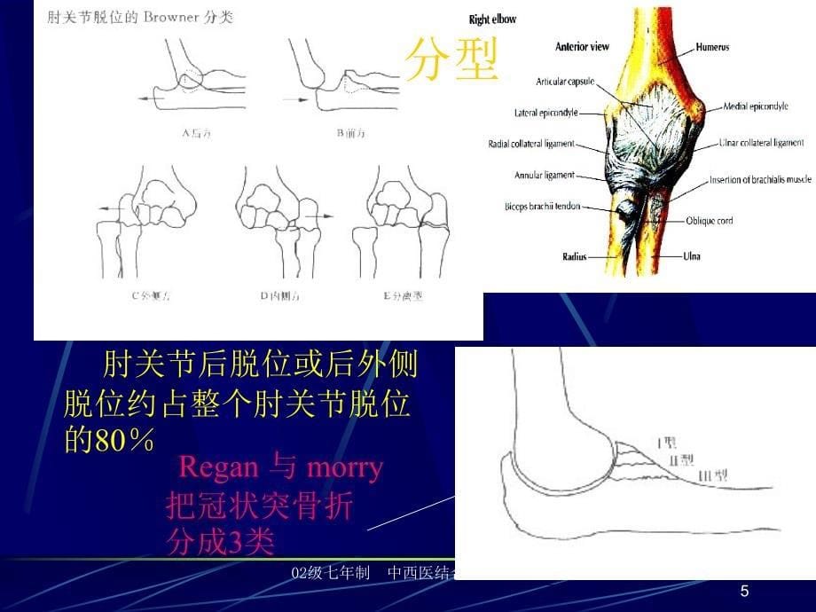 医药卫生肘关节脱位课件_第5页