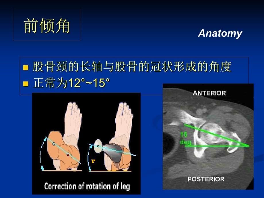 股骨颈骨折朱ppt课件_第5页
