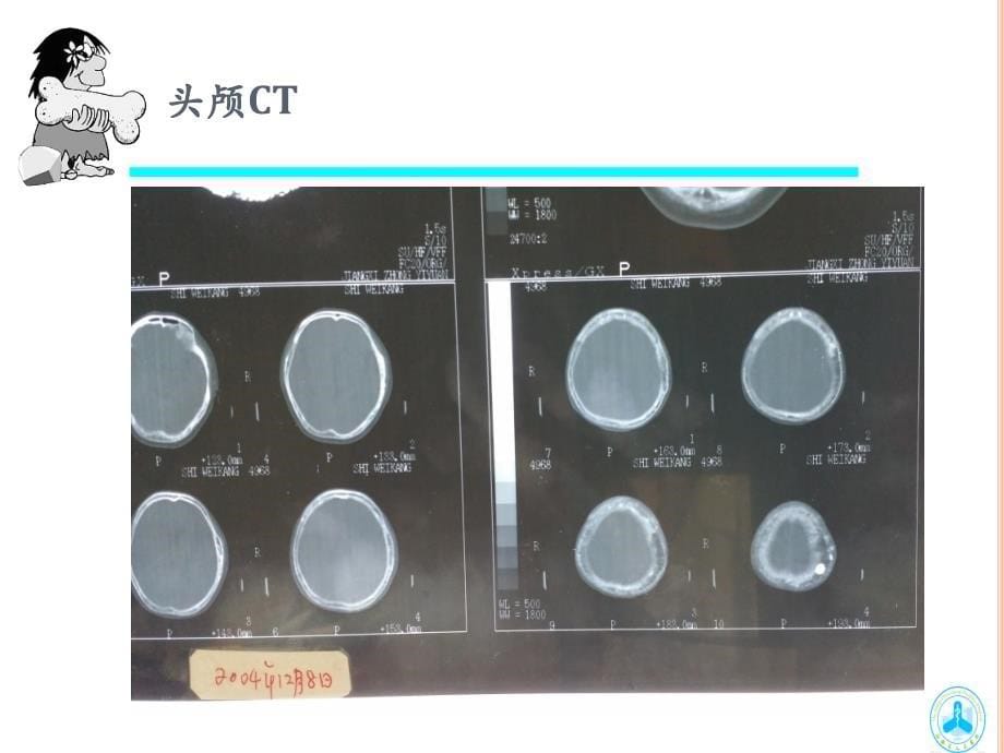 畸形性骨炎2015月24日课件_第5页