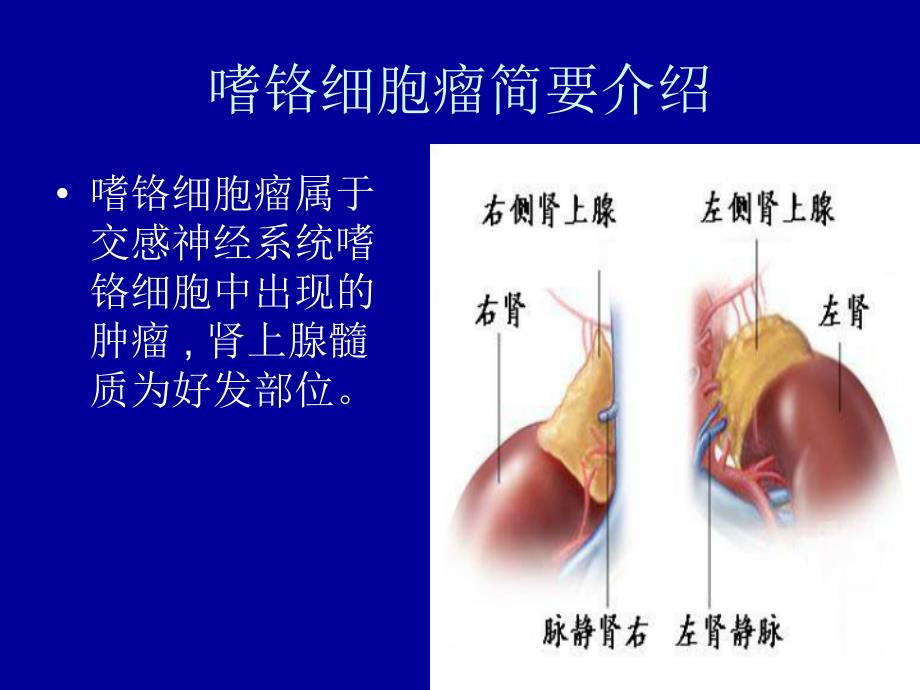 嗜铬细胞瘤课件_9_第2页