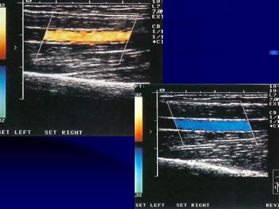 周围血管疾病多普勒超声检查课件_1_第5页