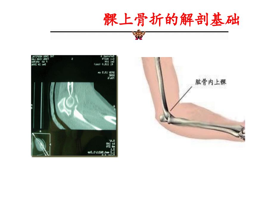 小儿肱骨髁上骨折的护理课件_第4页