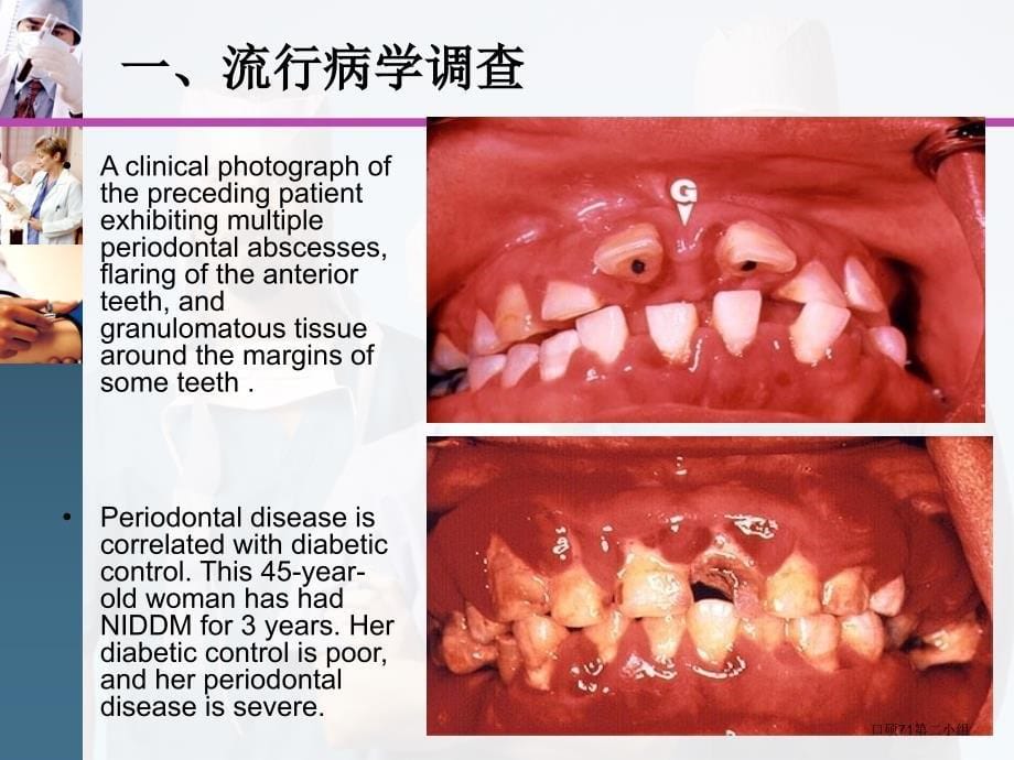 糖尿病和牙周炎课件_第5页