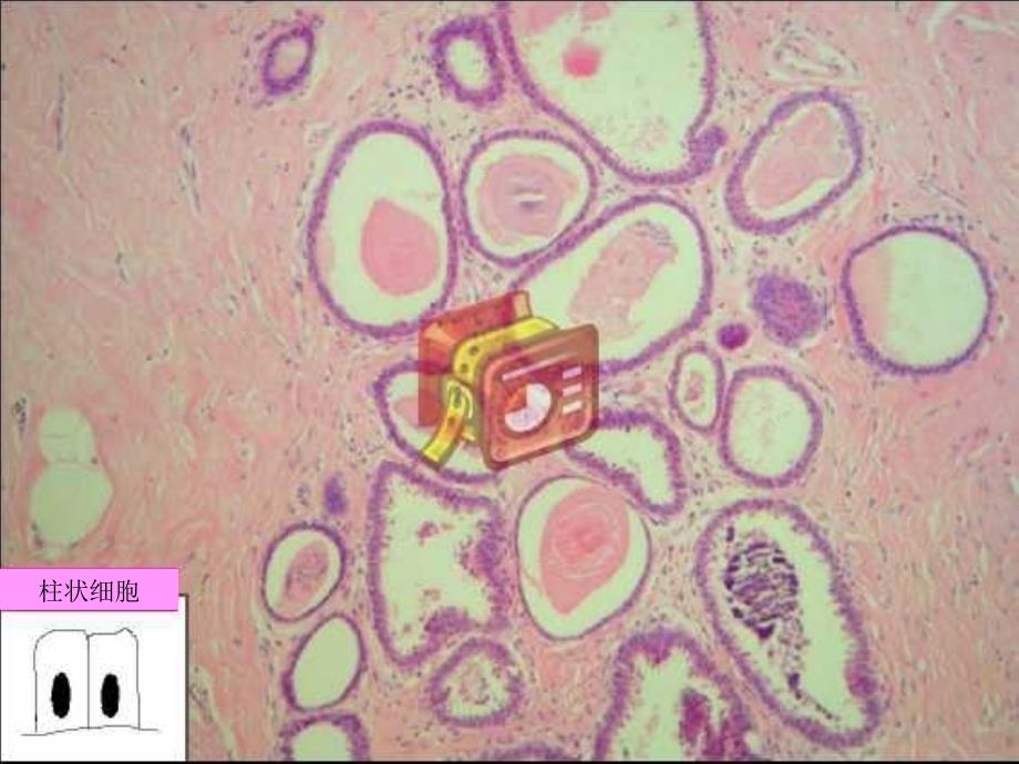 乳腺柱状细胞病变课件_第4页