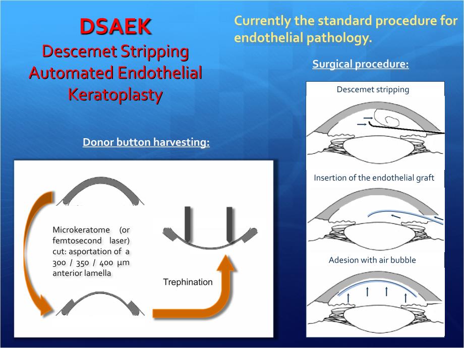 variations within endothelial grafts for dsaek 厚度变化范围内的内皮移植角膜内皮移植术课件_第2页