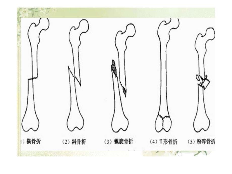 第三节 脊柱骨折及脊髓损伤病人的护理课件_第5页